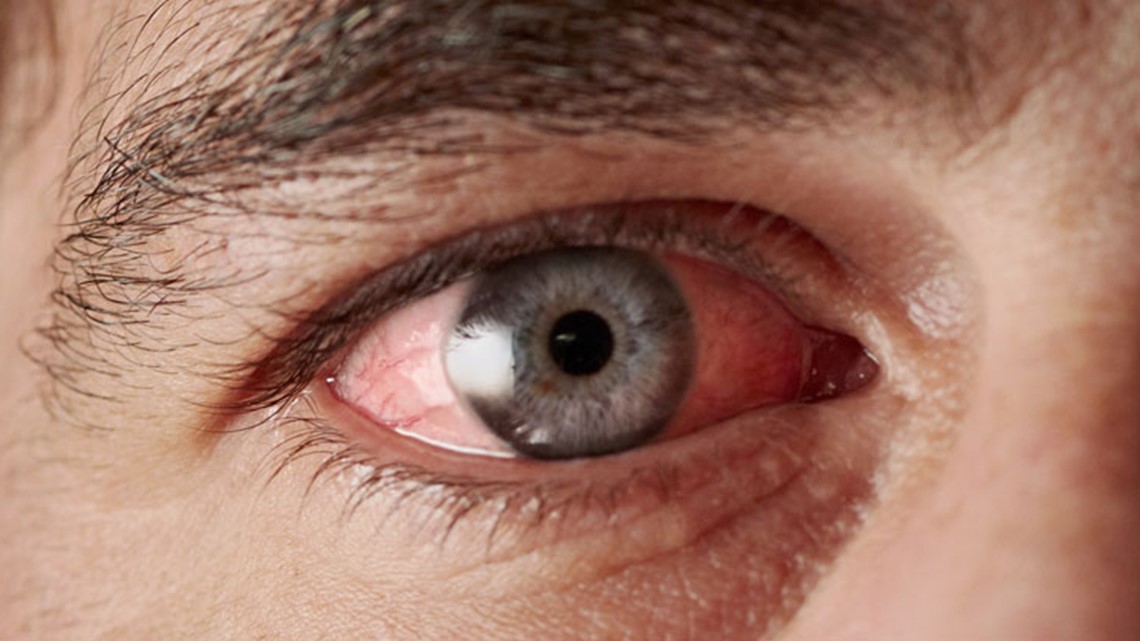 Experts: In uncommon cases, pink eye was an early indication of coronavirus