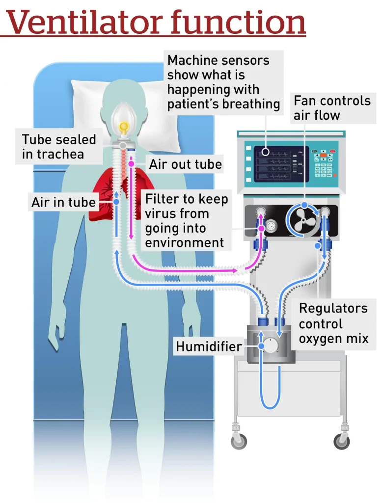 What is a ventilator and who gets one if COVID-19 turns catastrophic in Canada? | CBC News