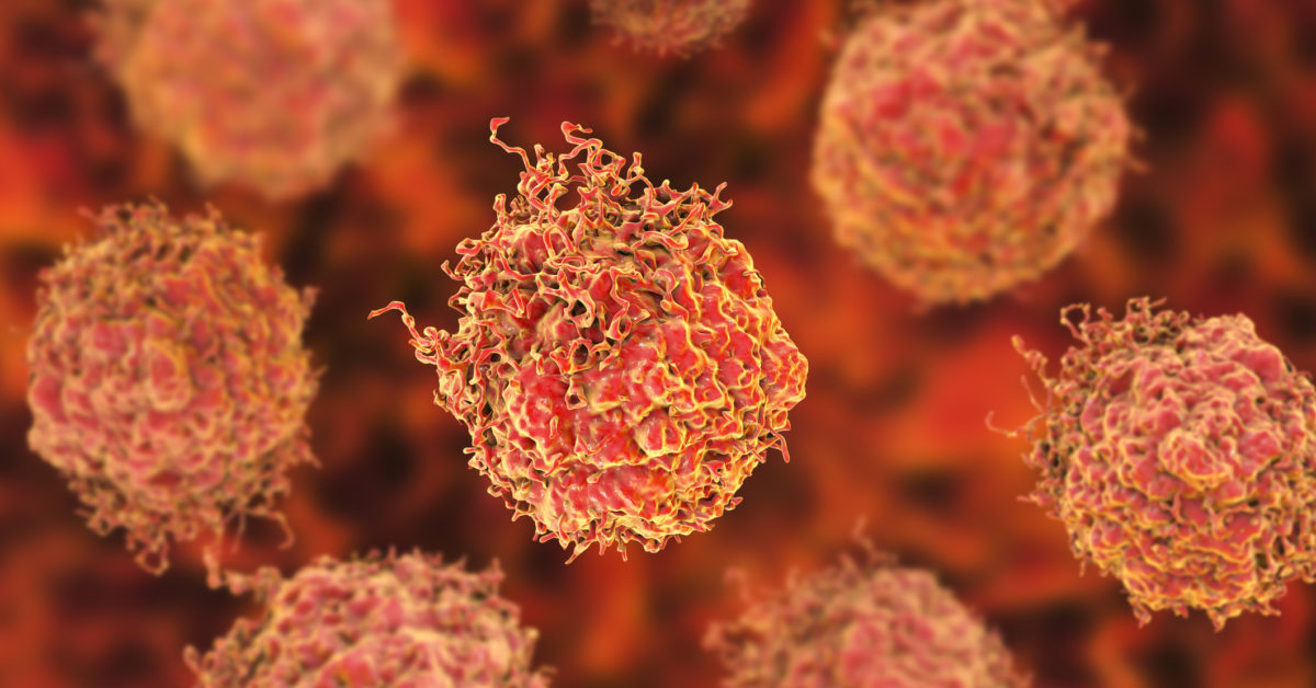 Tumor cell type identified that makes prostate cancer more aggressive