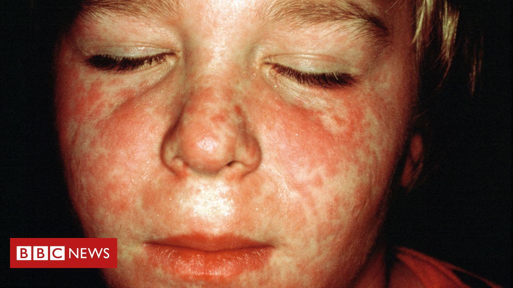 Measles revival fear in the middle of coronavirus