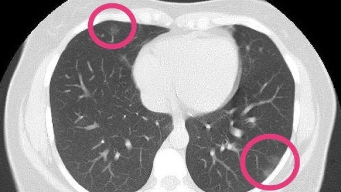 A seemingly healthy woman demanded a CT scan. Her lungs showed COVID-19