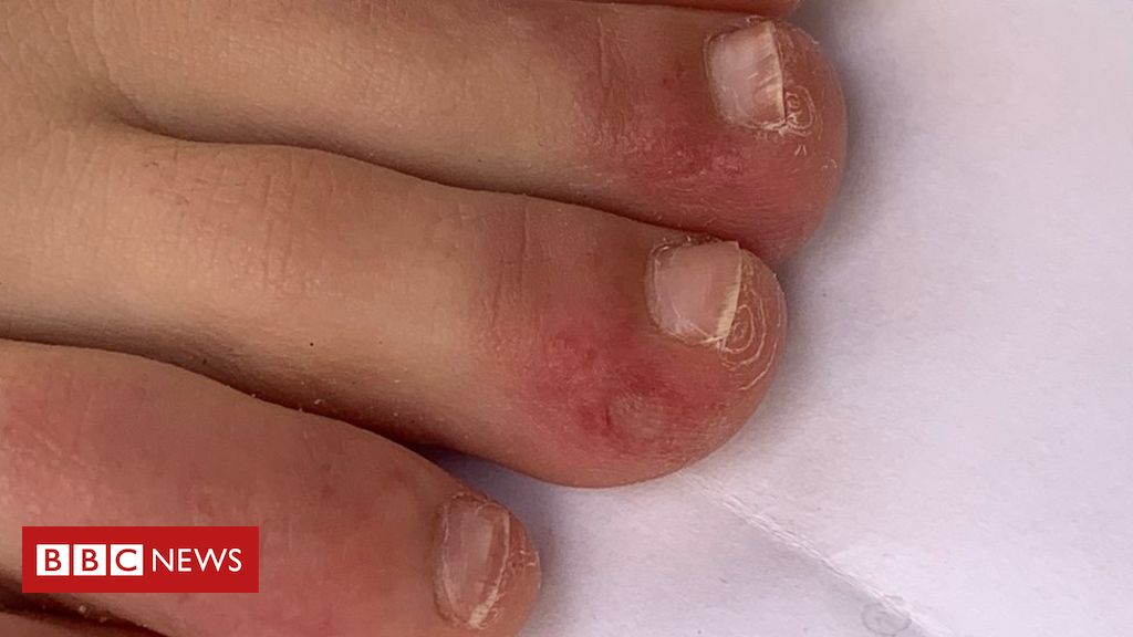 ‘Covid toe’ and other rashes puzzle medical professionals