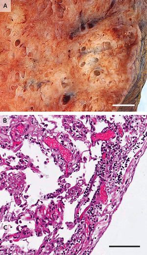 Pulmonary Vascular Endothelialitis, Thrombosis, and Angiogenesis in Covid-19