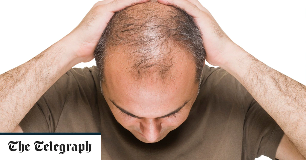 Bald guys at higher danger of extreme case of Covid-19, research finds