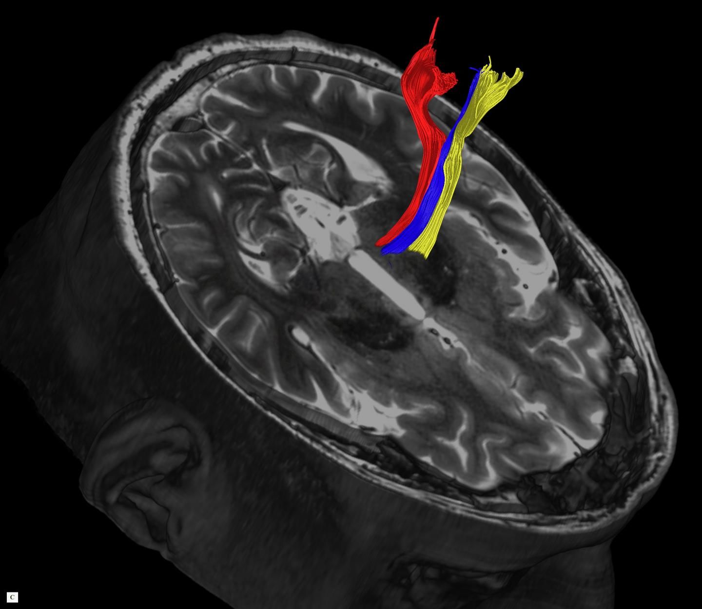 Advanced MRI scans may help deal with vital tremblings and Parkinsons illness