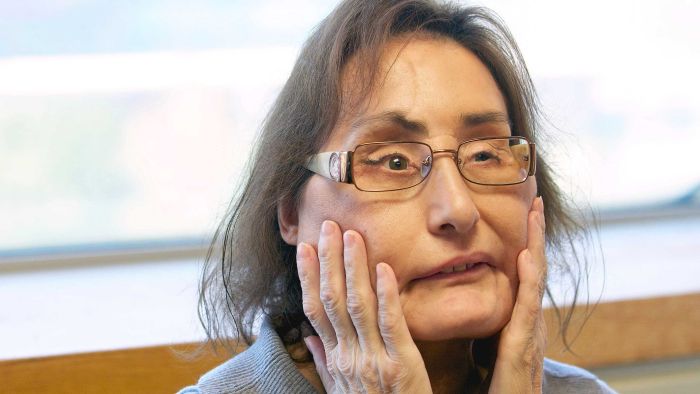 America’s very first partial face transplant recipient, Connie Culp, dies from an infection