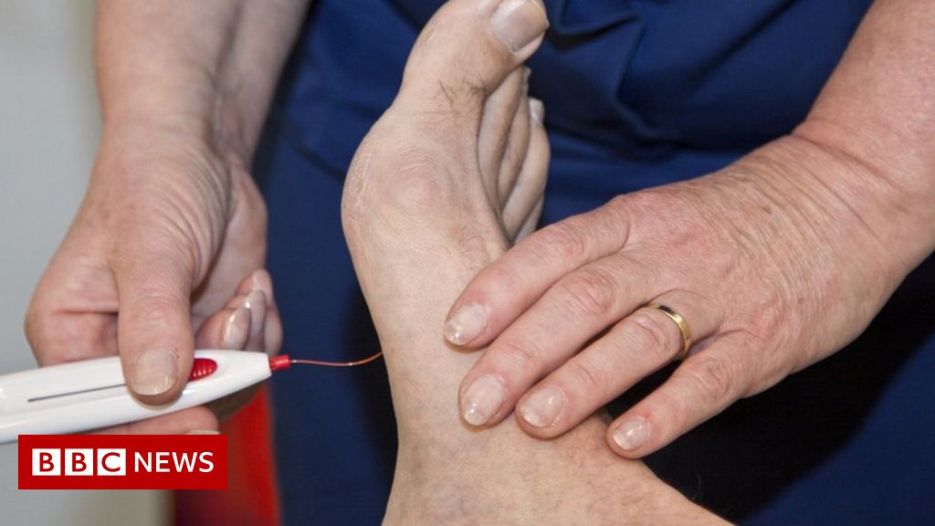 Dread over high charges of diabetes foot amputations