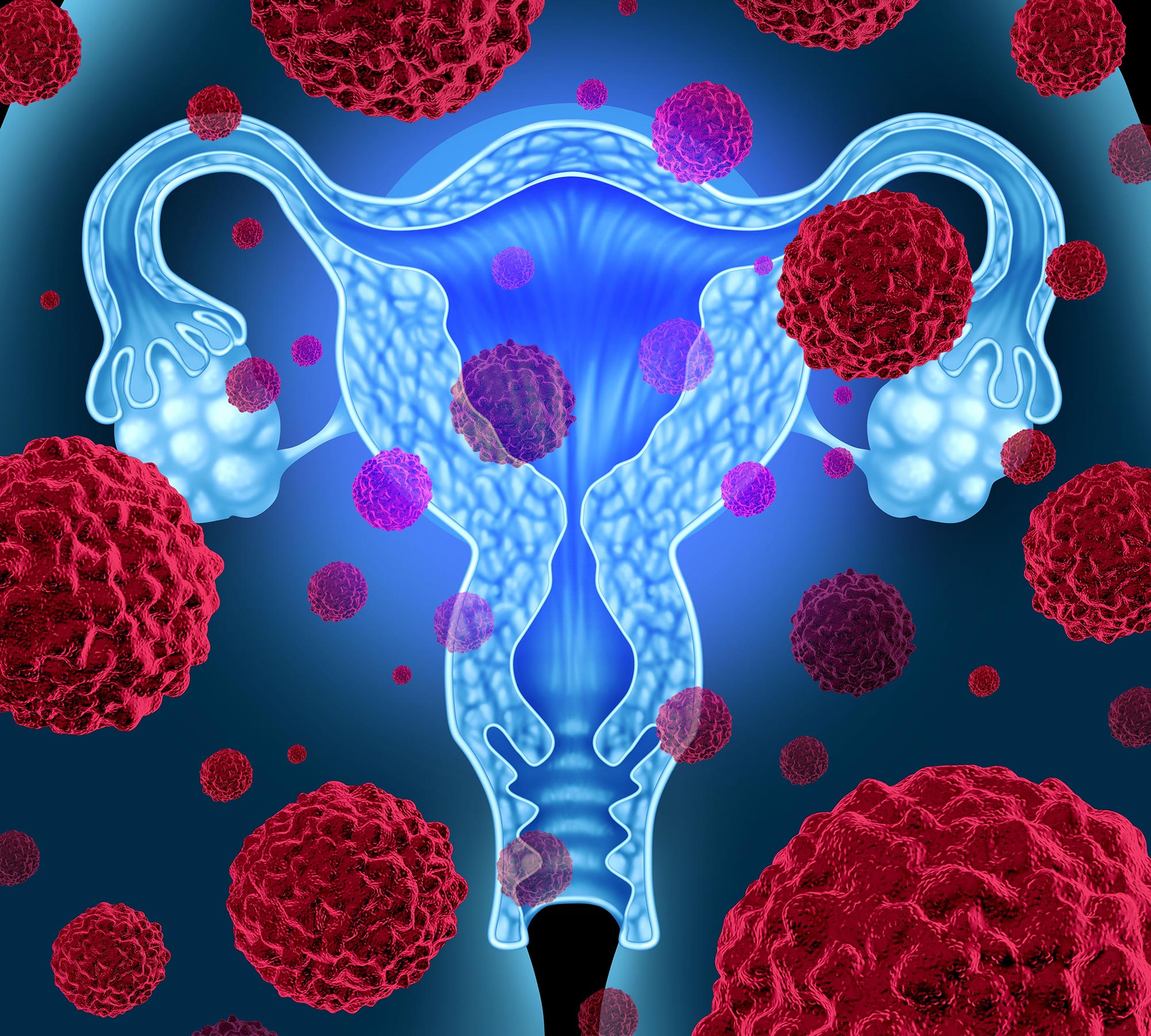 Excess Weight Nearly Doubles a Woman’s Risk of Endometrial Uterine Cancer