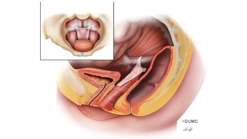 Which Surgical Methodology Is Handiest for Pelvic Prolapse?