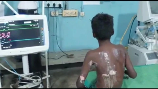 Students hurl caste slur at Tamil Nadu minor, push him into fire; booked