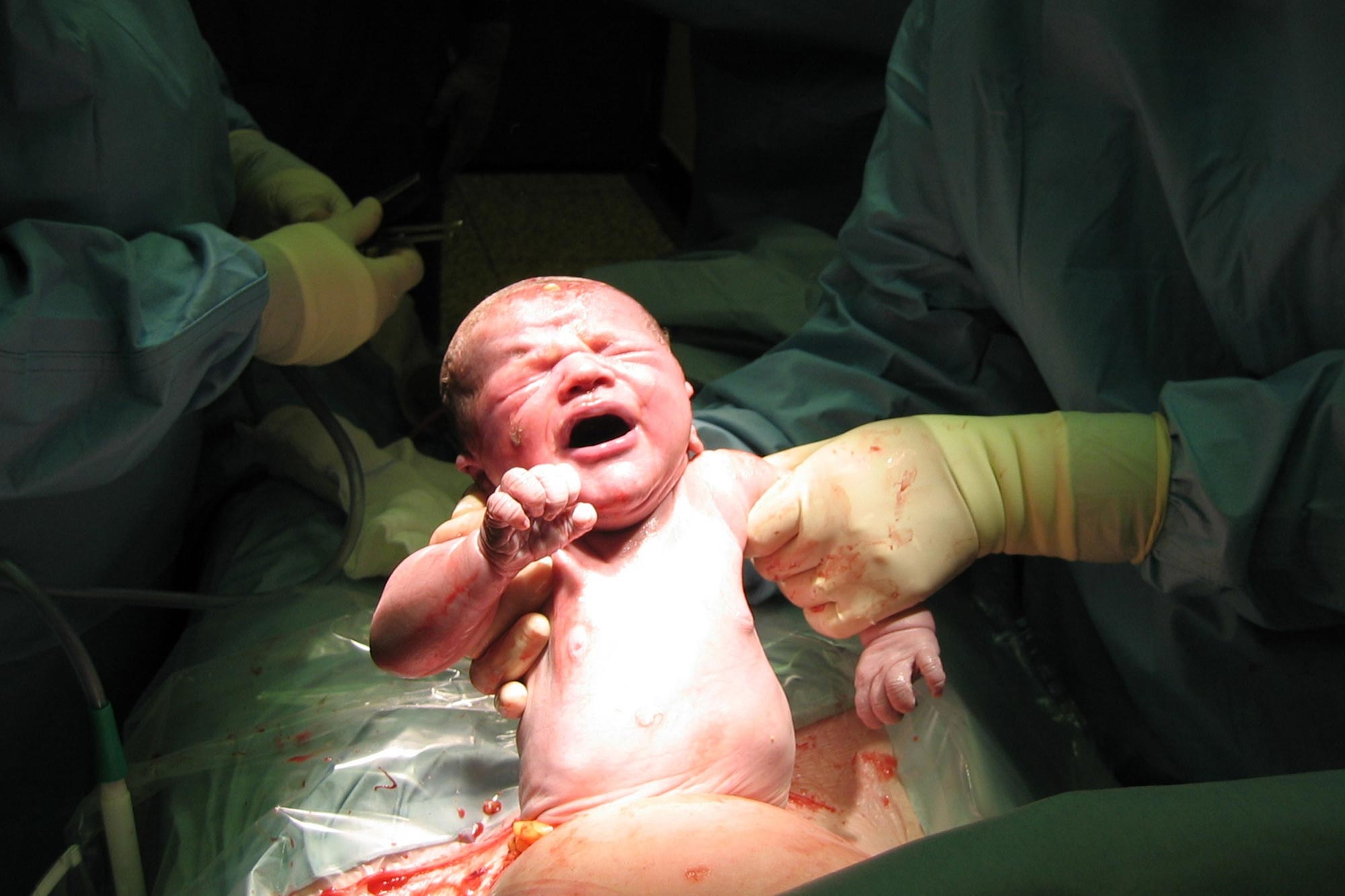 Cesarean Births No longer Linked to Elevated Probability of Meals Hypersensitive response Right by First Year of Lifestyles