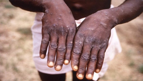 US confirms first case of Monkeypox: What’s the virus and what are its indicators