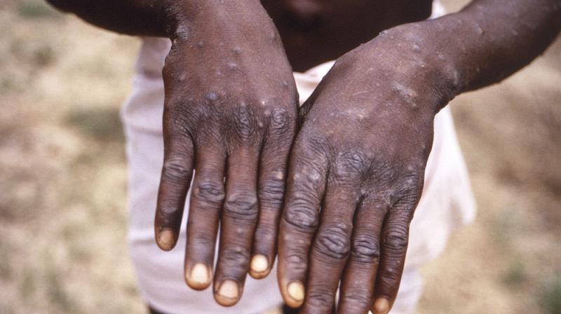 Airports to veil passengers strolling back from monkeypox-hit nations