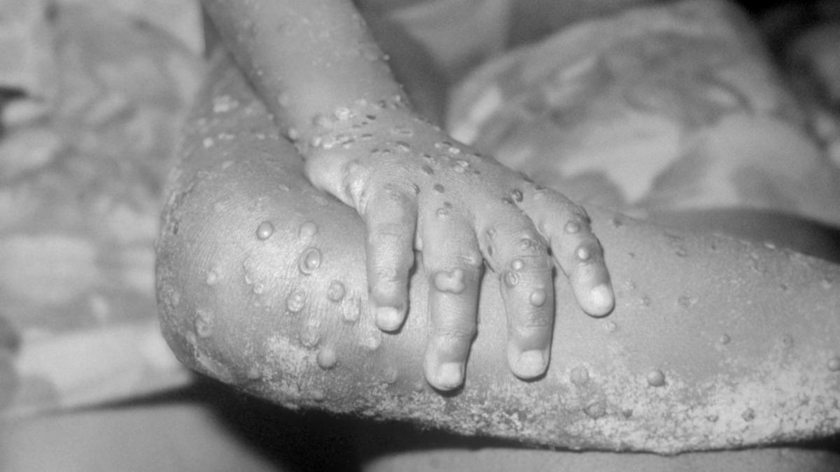 Monkeypox has made it to Australia. So what is it, what are the symptoms and the device in which will we prevent the unfold of the virus in 2022?