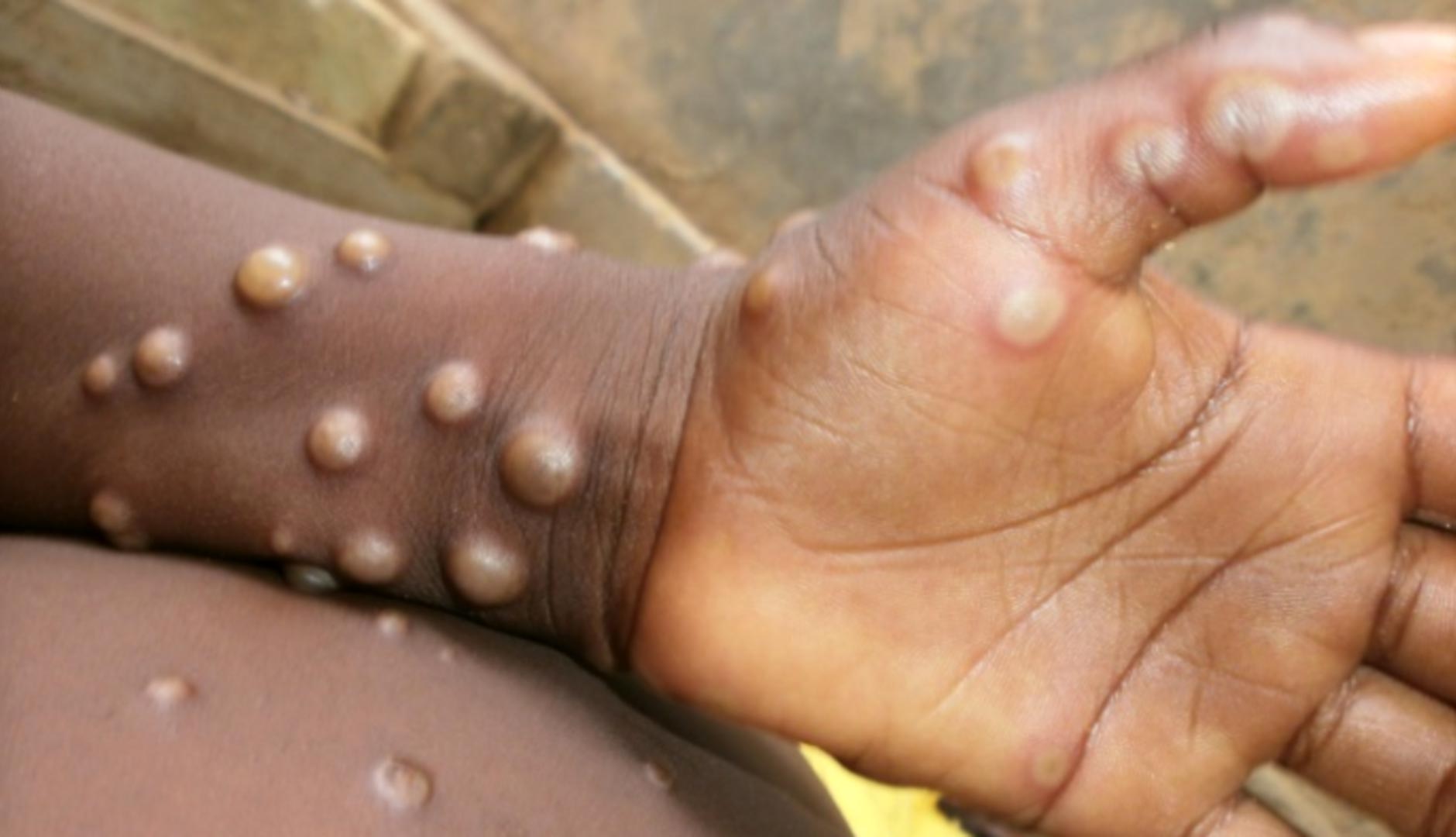 What Is Monkeypox? A Microbiologist Explains What’s Identified About This Disease