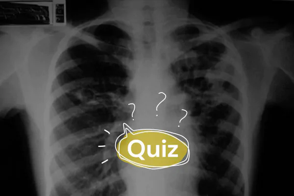 Quiz: Paciente adolescente apresenta febre, tosse e emagrecimento há três semanas. O que será?