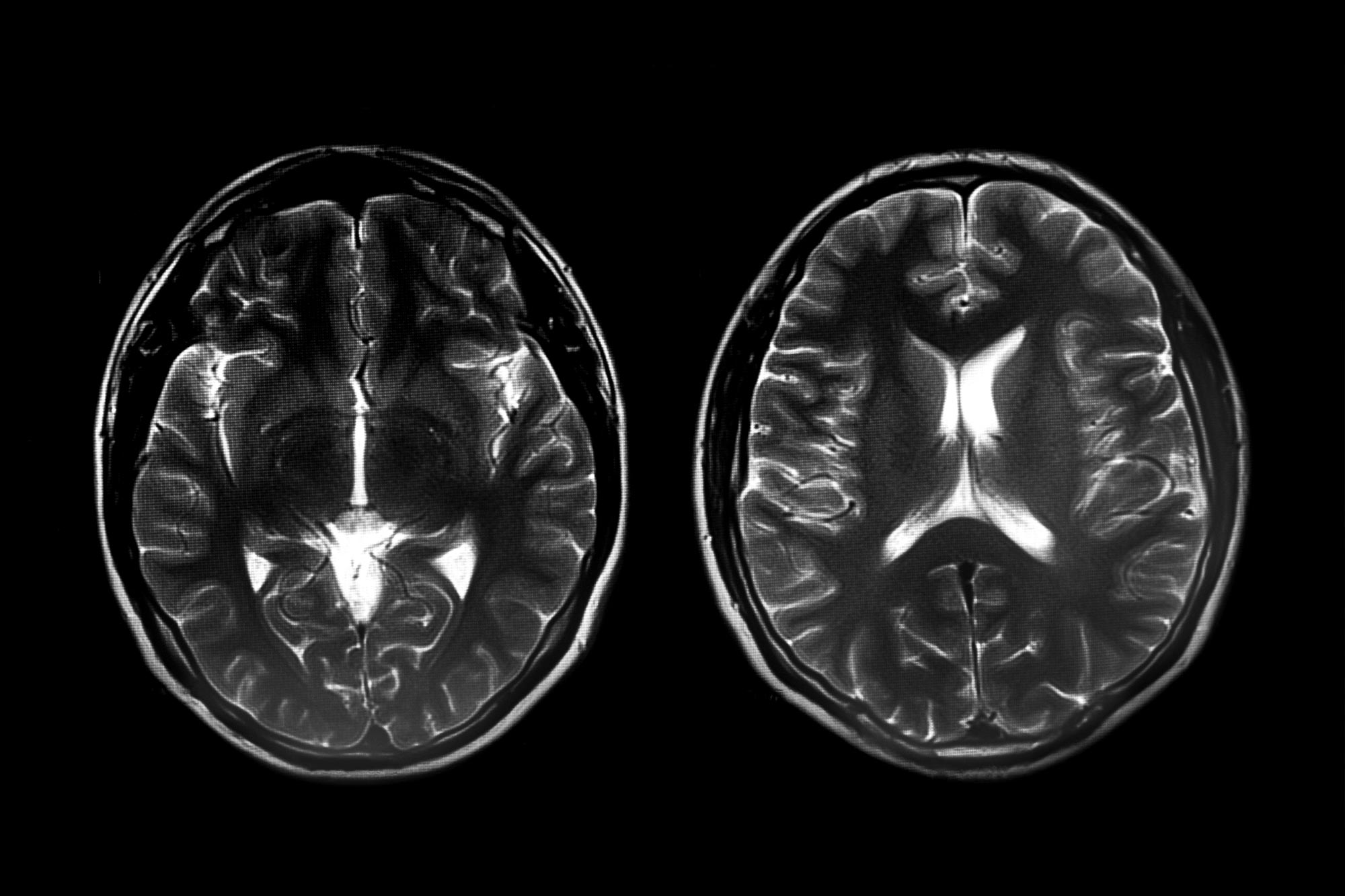 Adjustments in Brain’s Visible Processing Areas in Infancy Earlier than Autism Prognosis