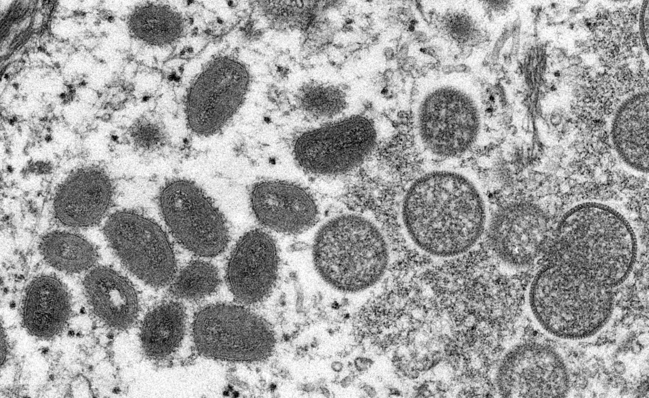 First Full DNA Sequencing of Monkeypox Virus in Switzerland — Indian ...