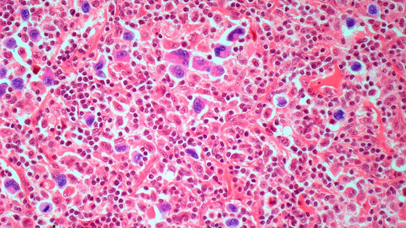 A Unique First-line Regimen for Superior Hodgkin Lymphoma?