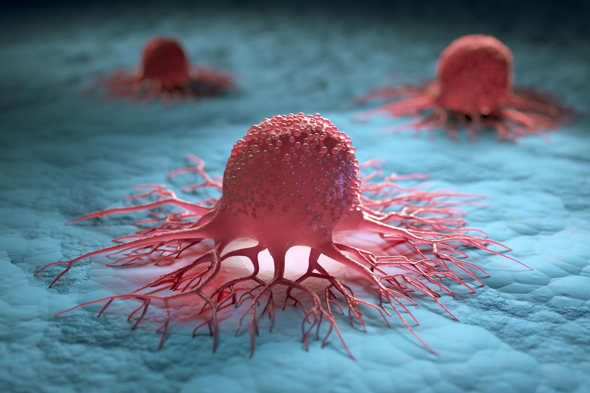 Scientists Survey an Alarming Rise in a Obvious Most cancers Variant