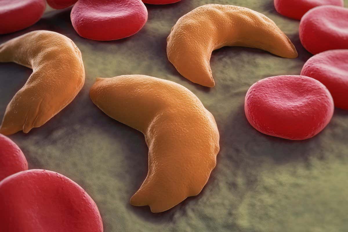 Formative years to gather CRISPR cure for sickle cell illness in trial