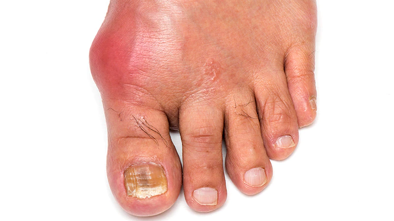 Alcohol Consumption Habits Can Predict Gout Tophi