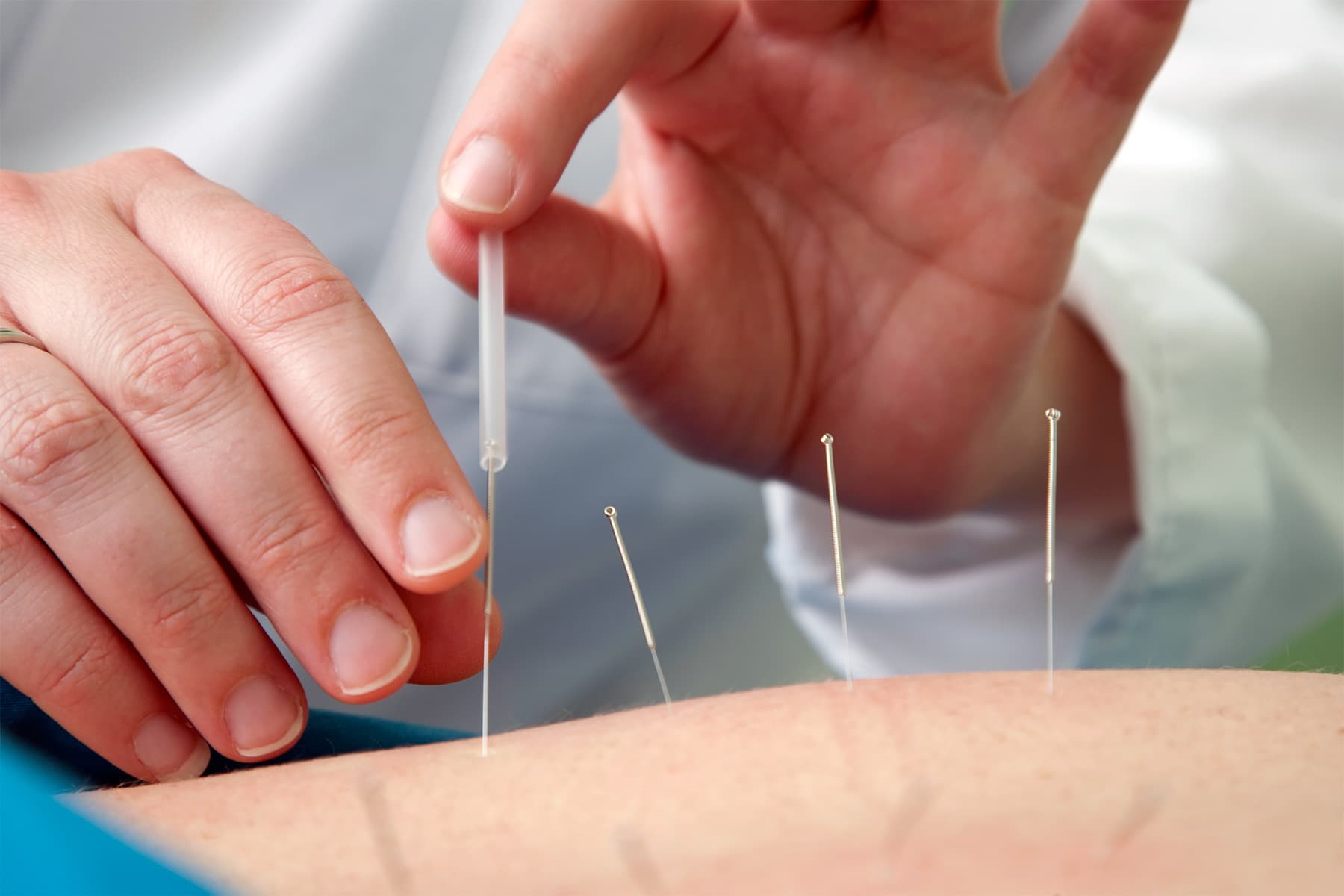 Dealing With Headaches? A Recent See Says Acupuncture May maybe maybe perhaps Back