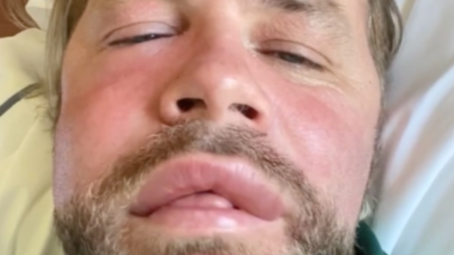 Westlife big name Brian McFadden shares hilarious bee sting photograph: ‘Free Botox and fillers!’