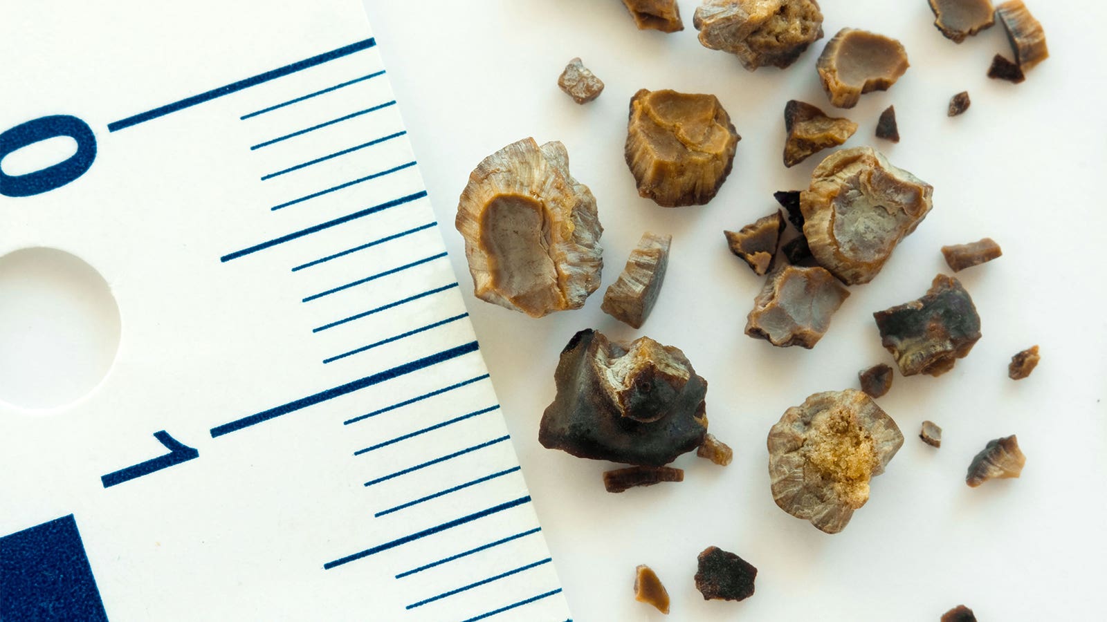 New Insights Into Hyperlink Between Kidney Stones, Urinary Tract An infection