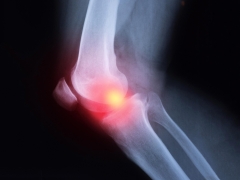 Painkiller Like Ibuprofen and Naproxen May Worsen Arthritis Inflammation