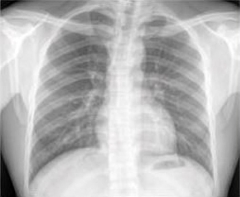 AI Predicts Future Heart Disease Risk Using Single Chest X-Ray