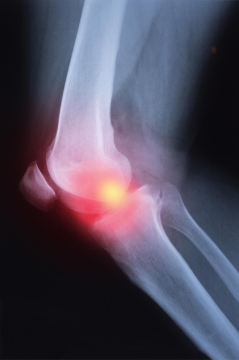 Groundbreaking Study Finds Treatment Effective for Rheumatoid Arthritis Patients