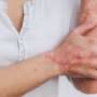 How to eliminate scratchy psoriasis