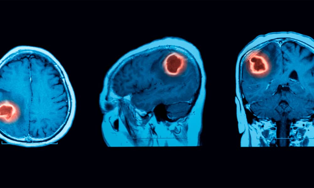 Logran una nueva técnica para tratar el growth cerebral más letal con quimioterapia