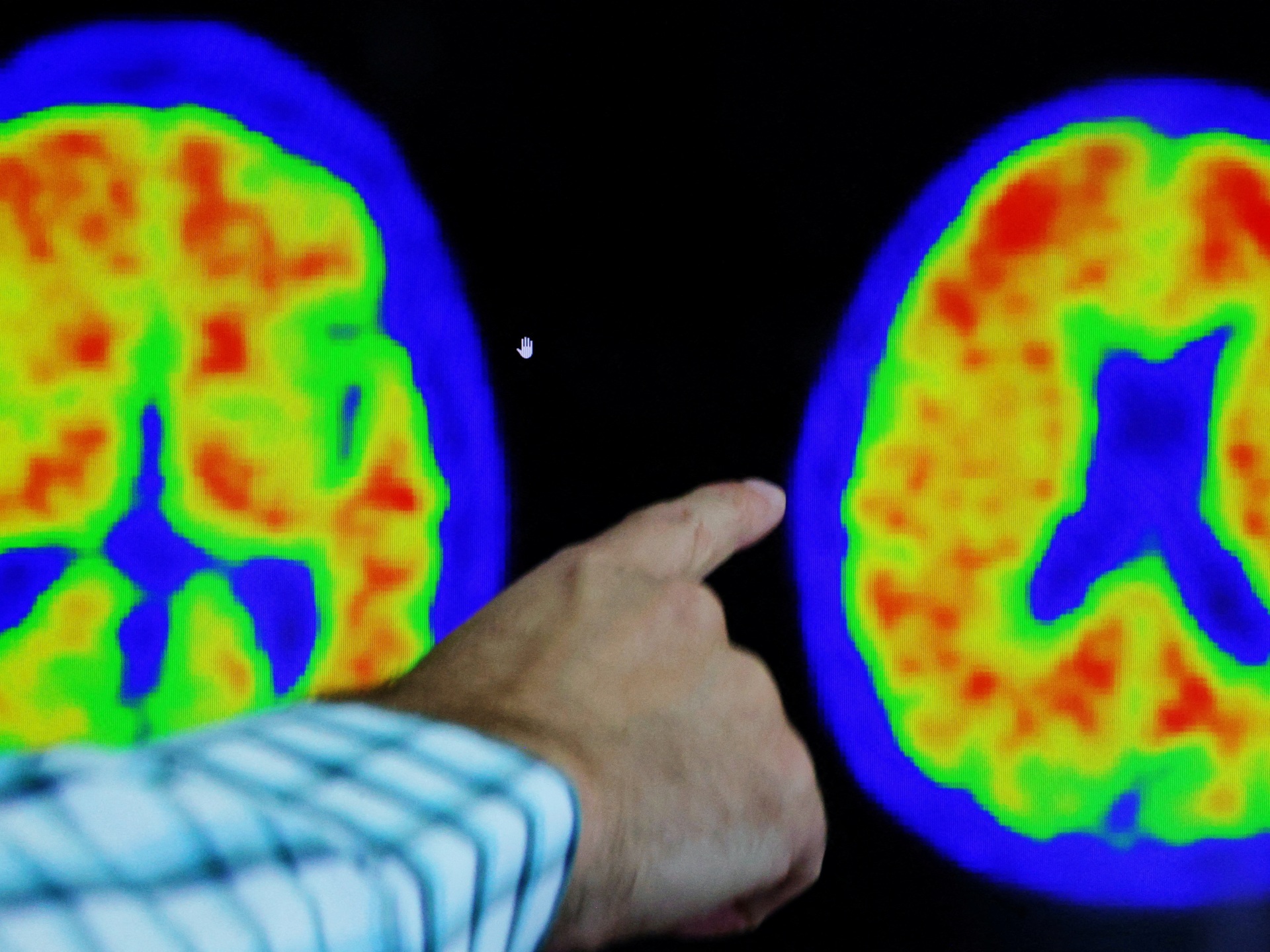 ‘Remarkable’ drug decreases Alzheimer’s decrease, research study programs