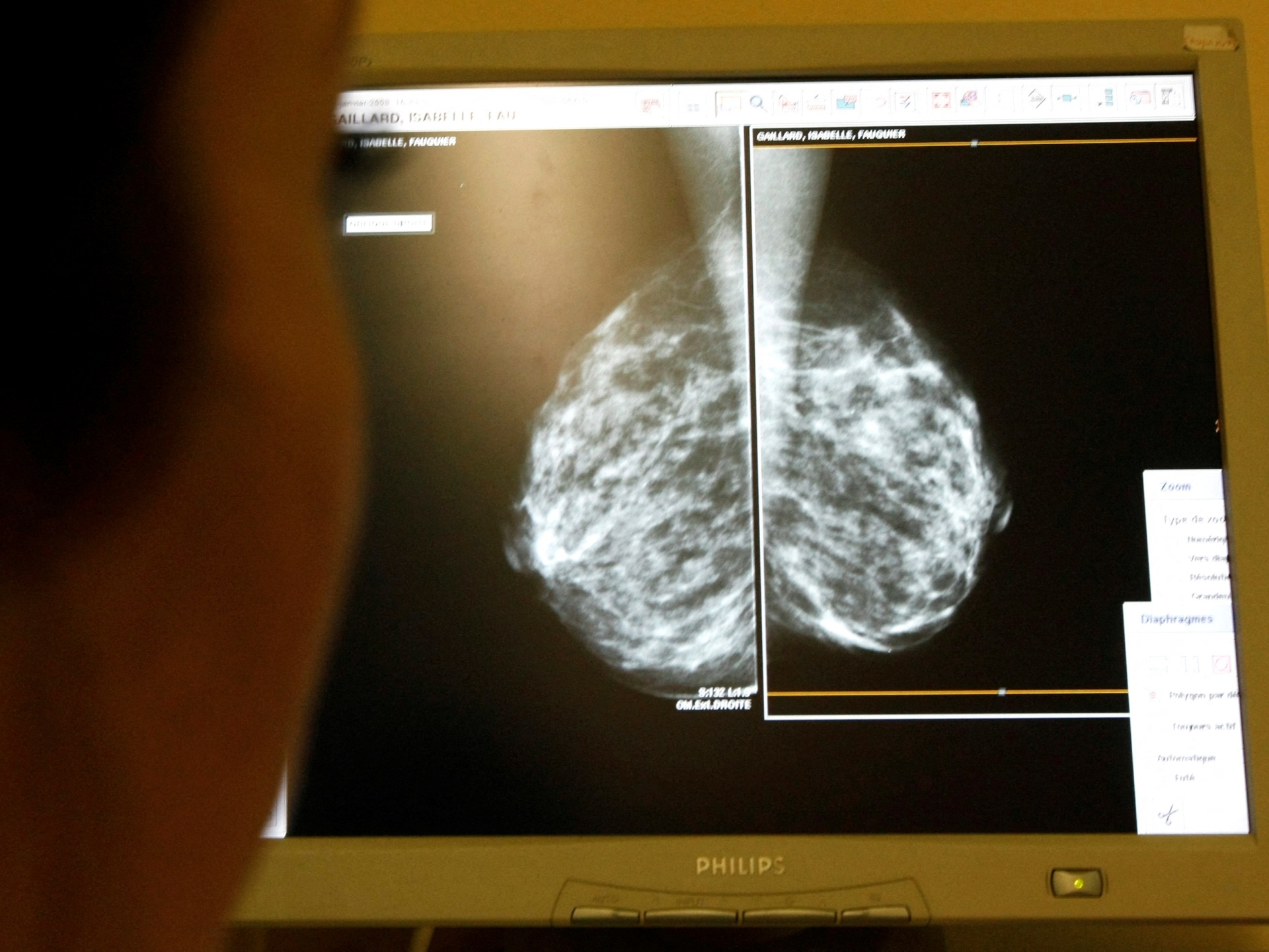 United States panel encourages breast cancer screenings ought to start at age 40