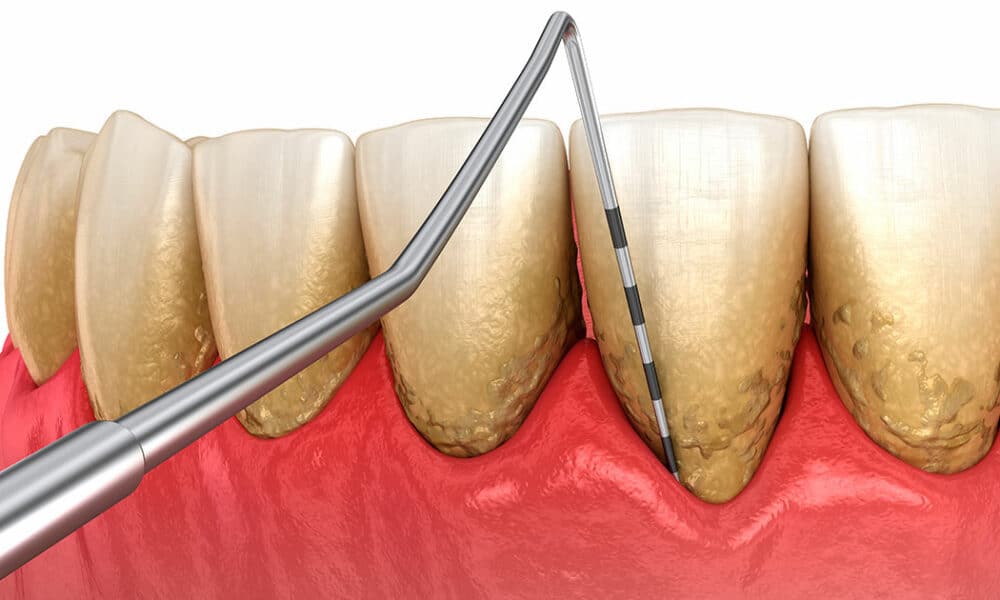 Las personalities trick periodontitis pueden tener el doble de riesgo de padecer Alzheimer y el triple de sufrir un ictus isquémico