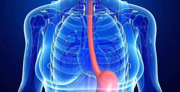 Câncer esofágico pós-bariátrica: a prevalência de refluxo pode favorecer o quadro?