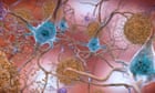 FDA advisors state brand-new Alzheimer’s drug lecanemab slows cognitive decrease