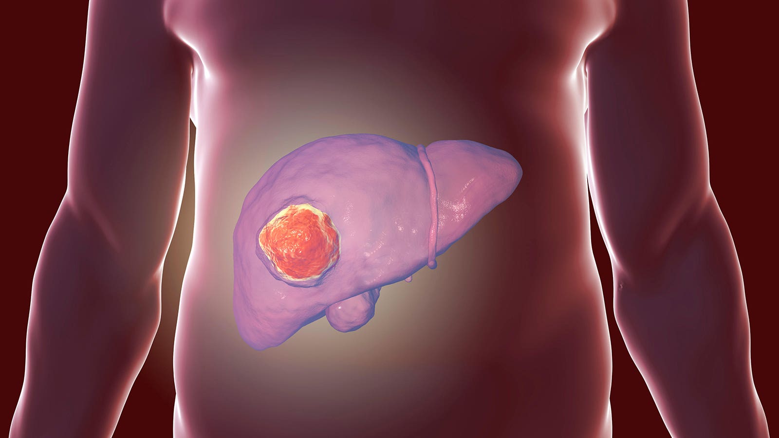 Unique Combination Boosts Survival in Unresectable Liver Cancer