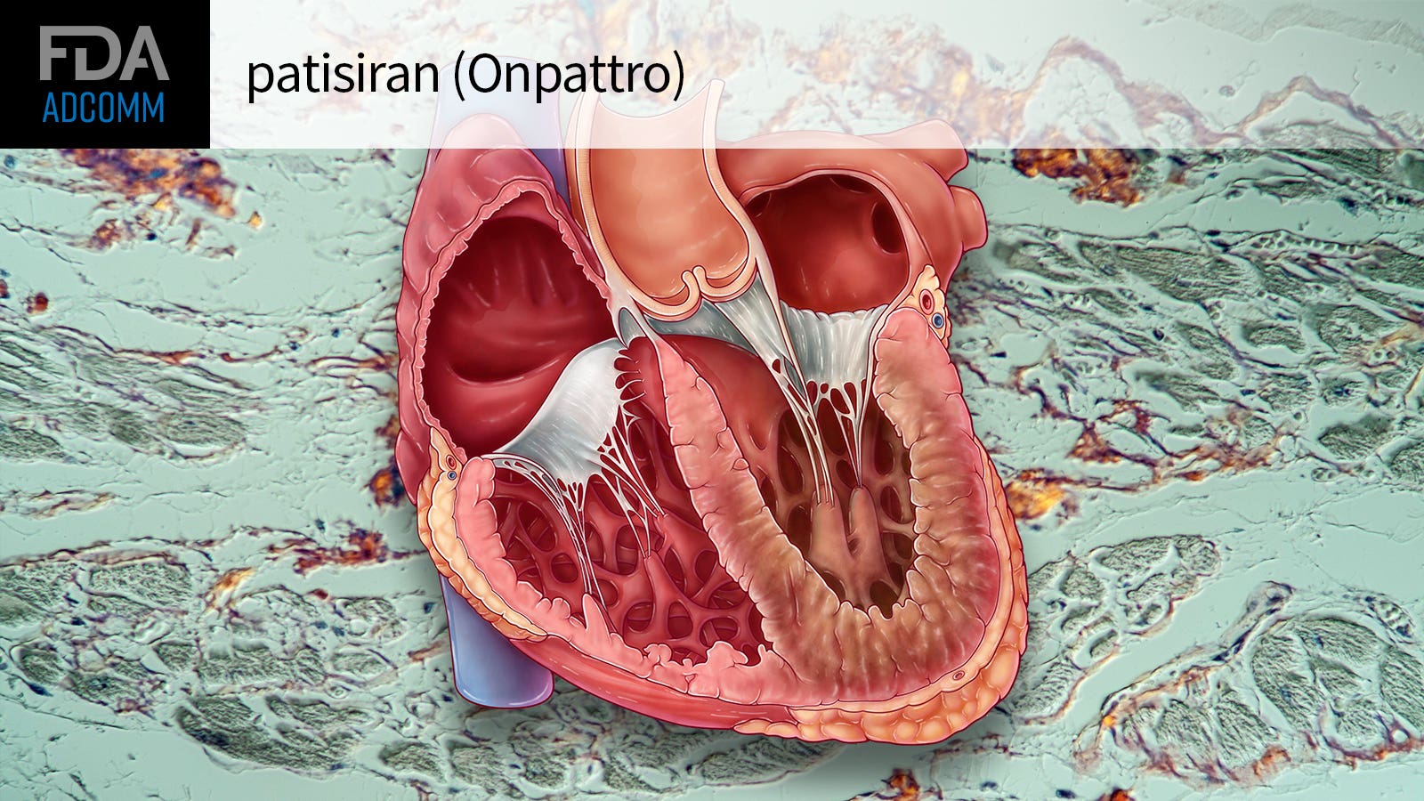 FDA Panel Reluctantly Backs Patisiran for ATTR Cardiomyopathy