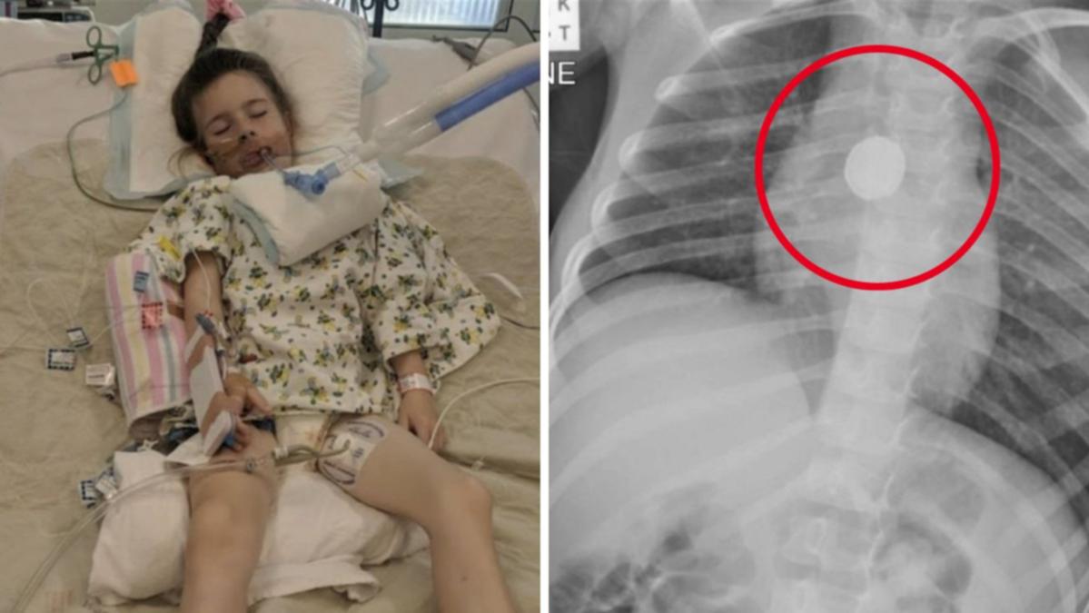 Victorian household’s 6 months of pain prior to finding small battery lagged child’s illness