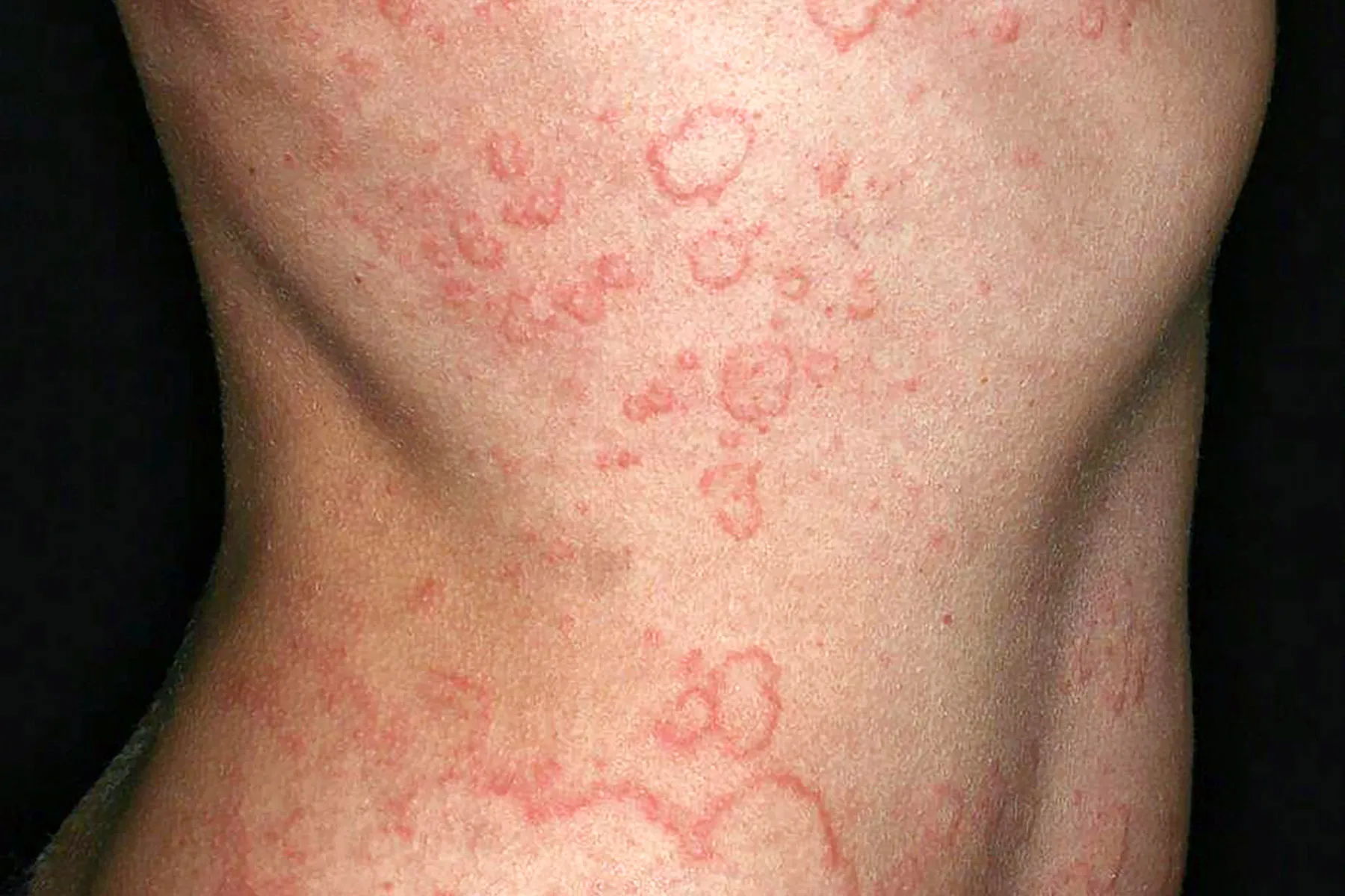 Persistent Spontaneous Urticaria: What to Know