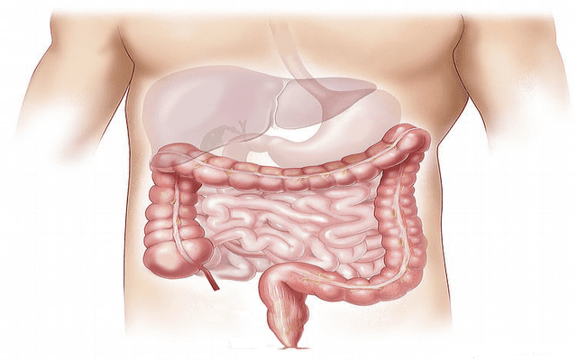 Tratamento das doenças inflamatórias intestinais: como romper o teto terapêutico?