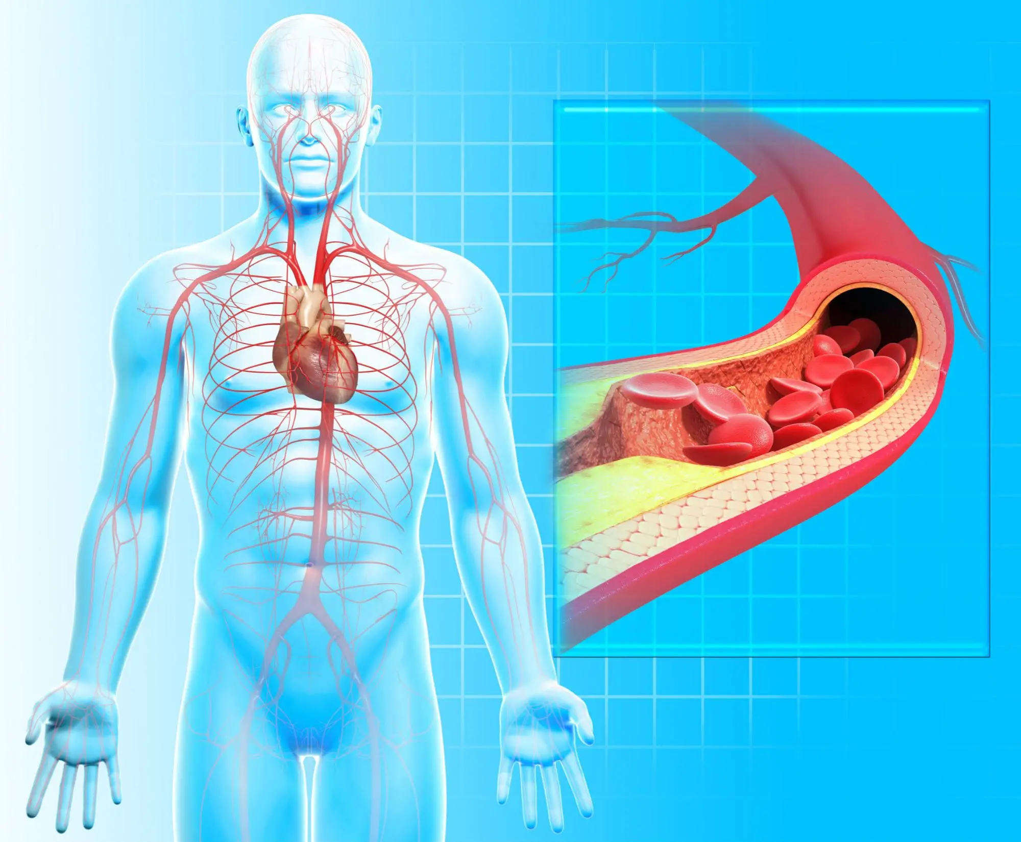 New Research Indicates That Atherosclerosis– Thought To Be Irreversible– Can Be Reversed