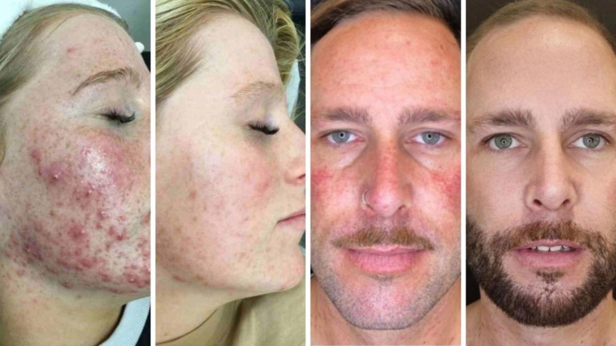 New Year, brand-new you: Why Aussies are raving about ‘fantastic’ facial treatments offered at Laser Clinics