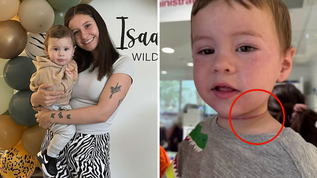 What is hair tourniquet? Aussie mum’s frightening caution after finding strangulation mark around kid’s neck