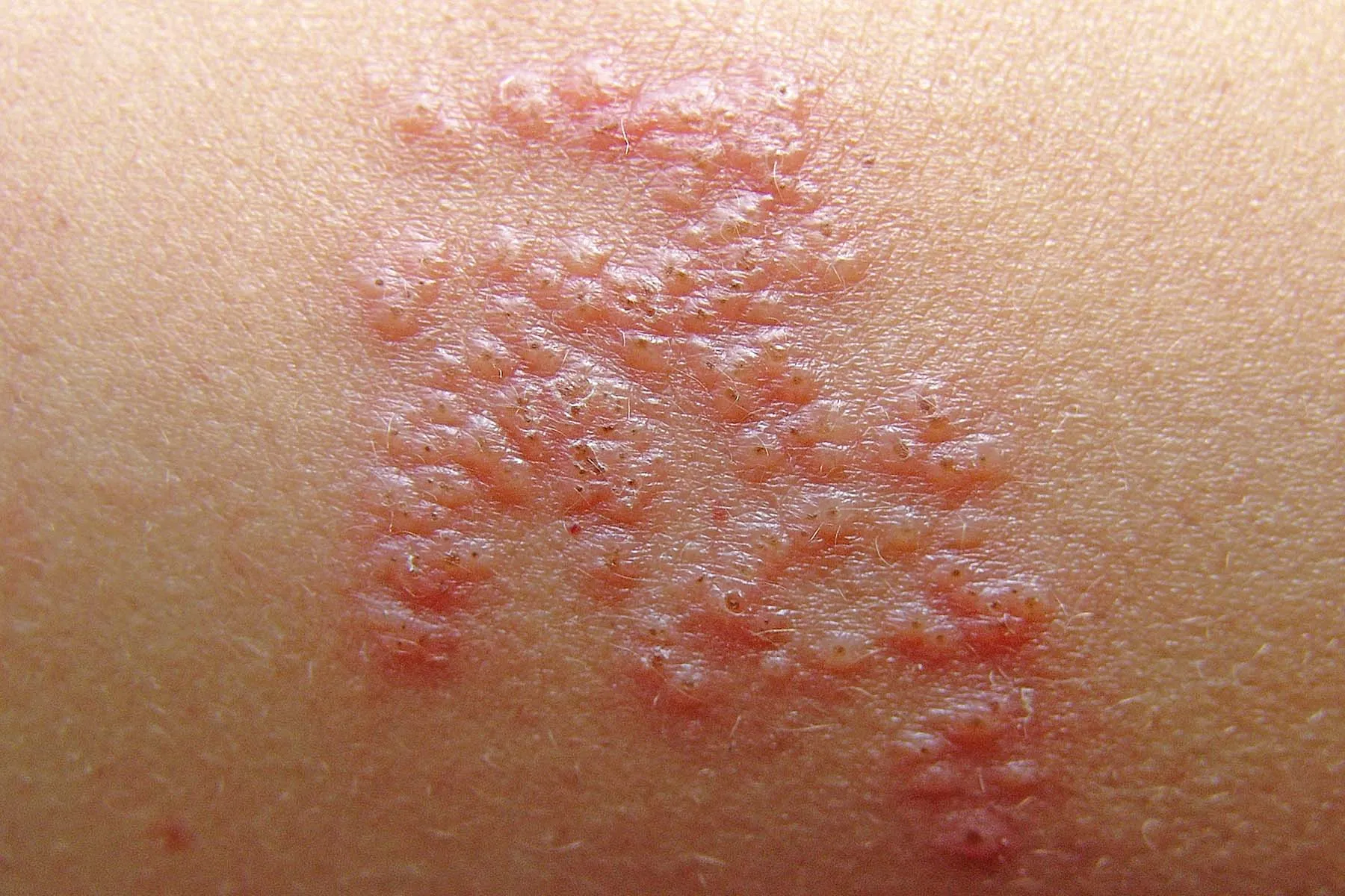 Pandemic and Costs Limited Use of Shingles Vaccine