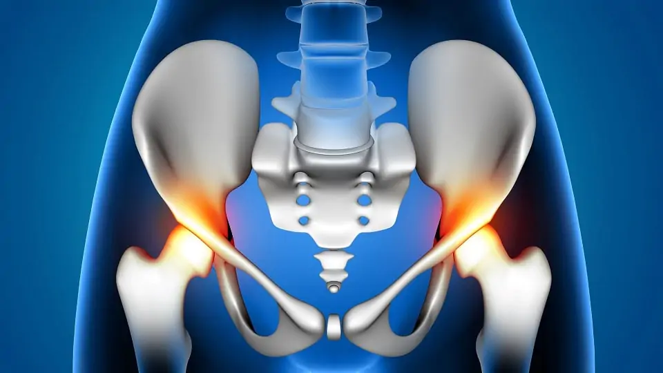 Frequência sonora perfect para fixação da copa acetabular não cimentada na ATQ?