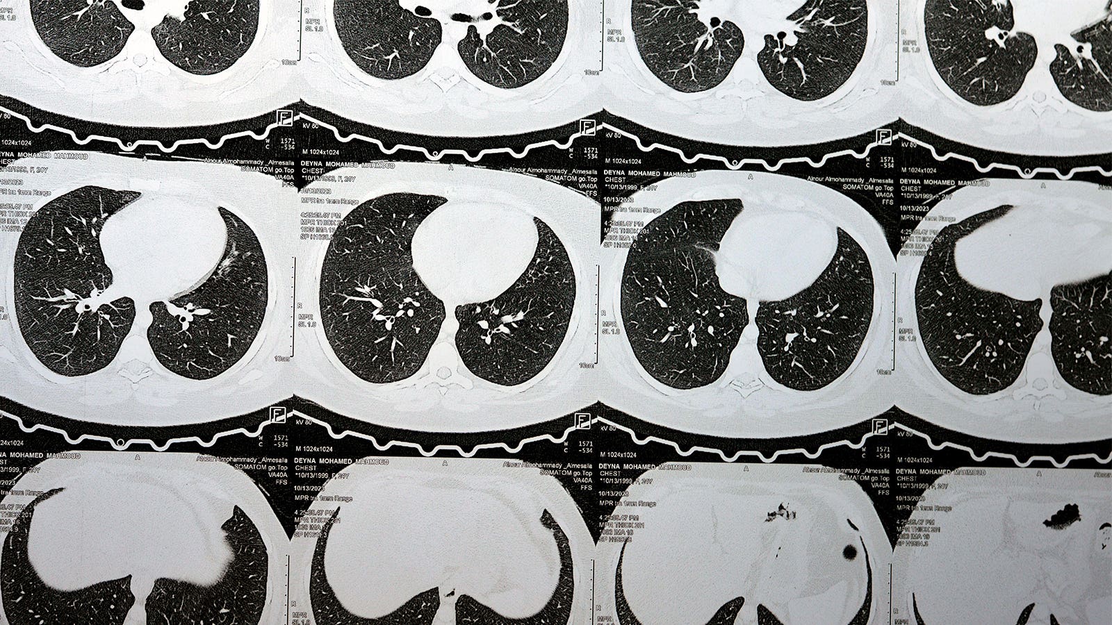 Advancing Interstitial Lung Abnormalities Linked to Respiratory Distress